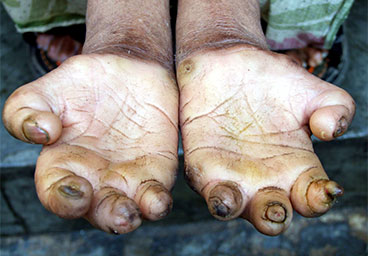 Sarva - Leprosy